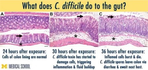 C diff effects