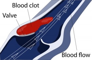 blood_clot