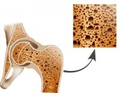Osteoporosis in femur bone, human bone anatomy.